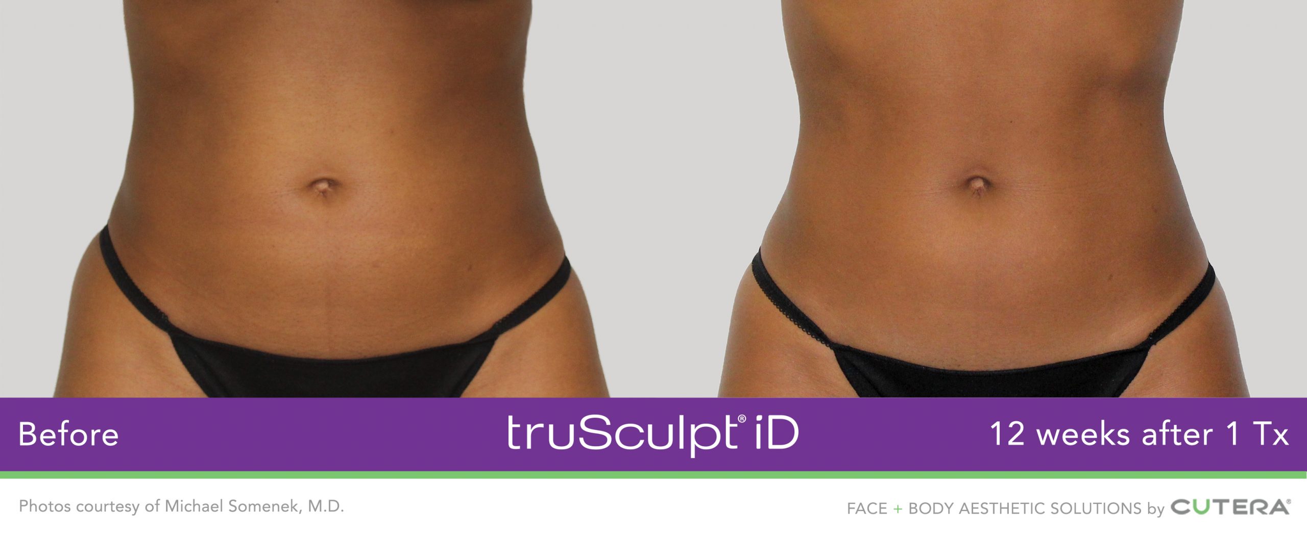 truSculpt-iD-Somenek-3